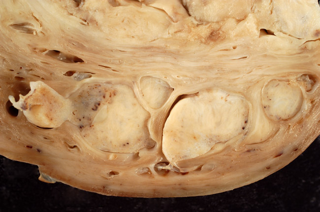 Intravaskuläre Leiomyomatose Uterus